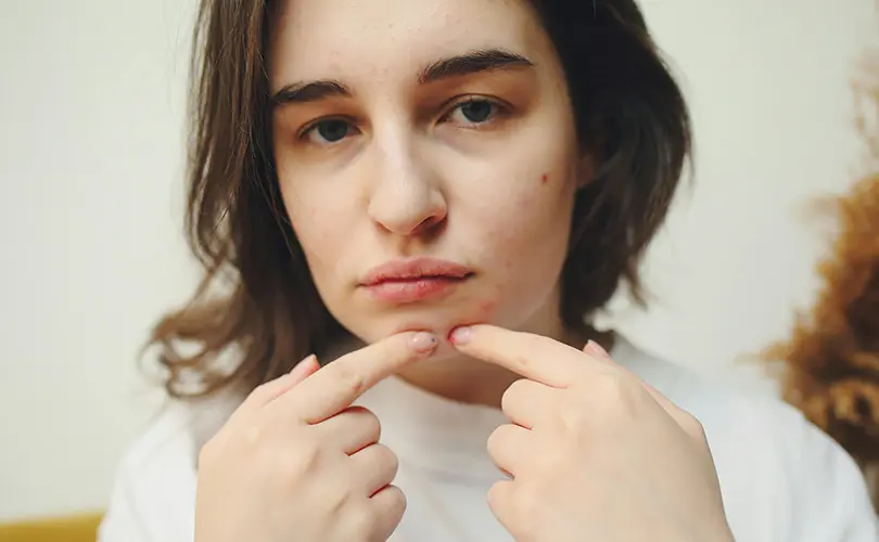 Cara Menghilangkan Jerawat